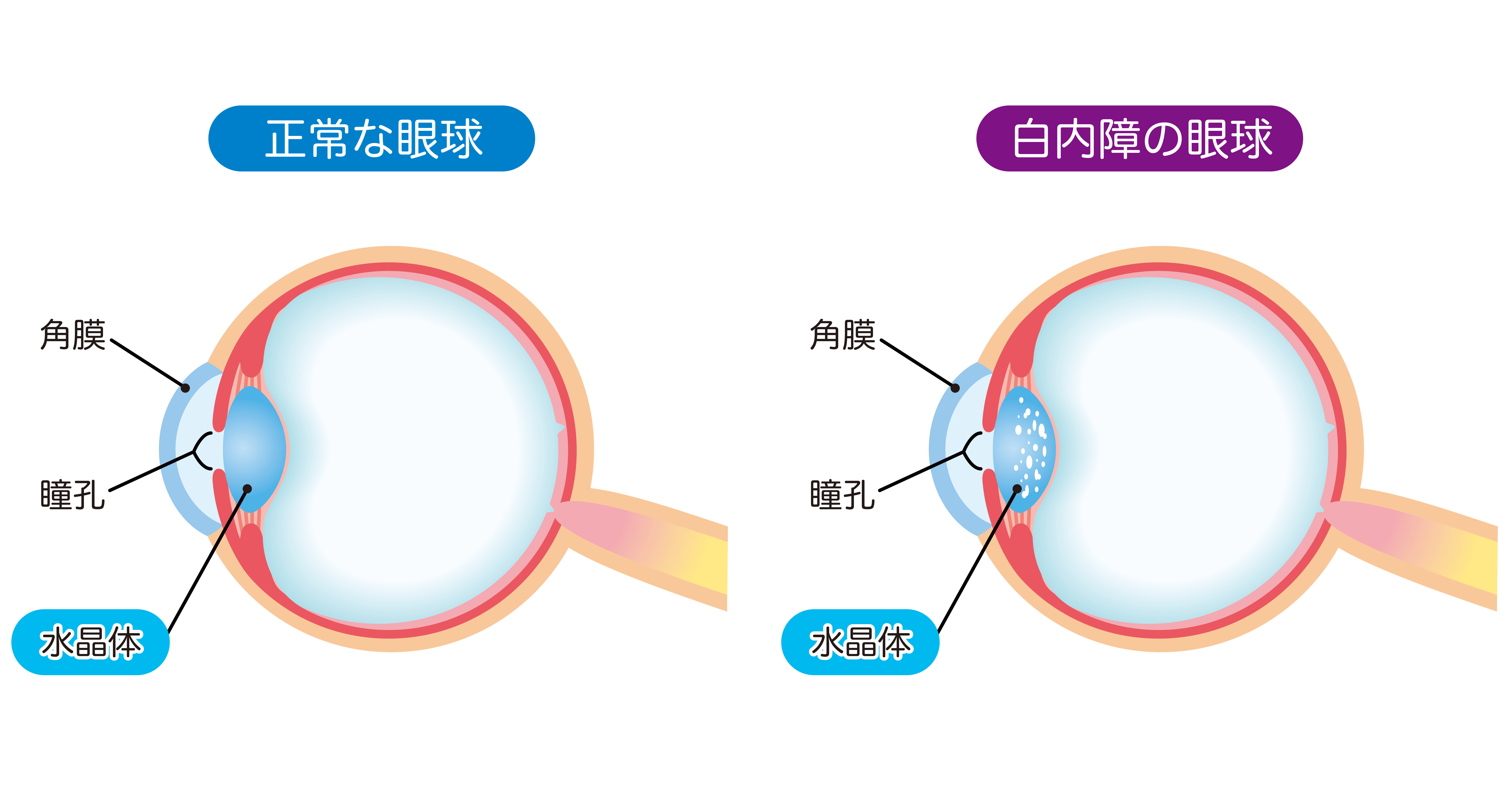 白内障の分類イメージ
